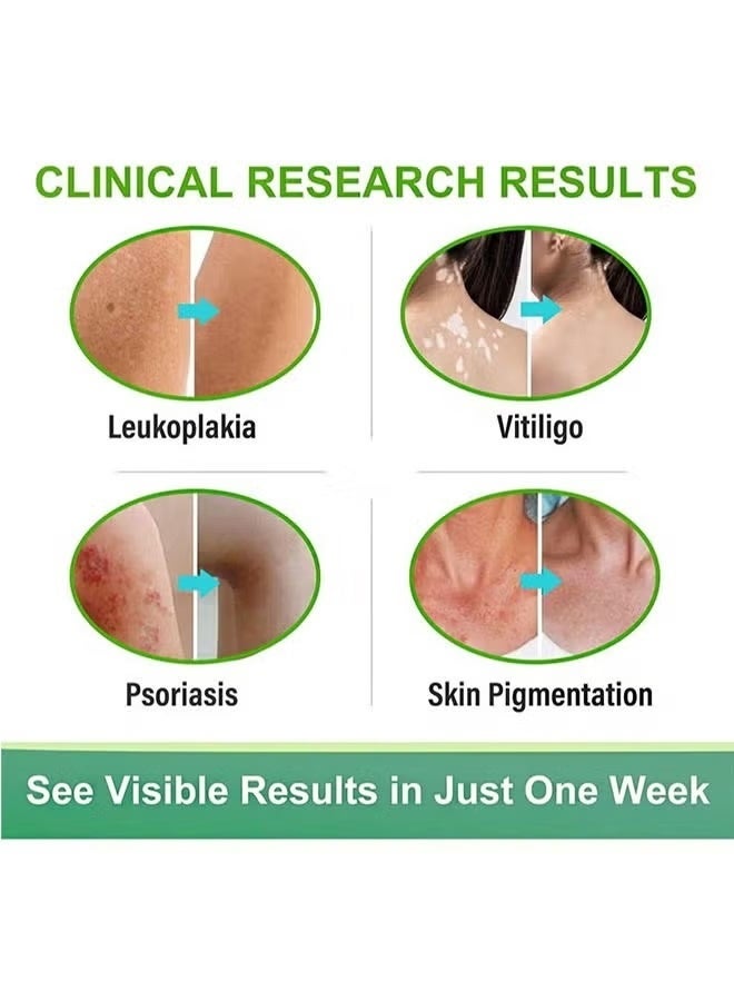 سوميفون مرهم كريم لإزالة البهاق 20 غرام، علاج البهاق الجلدي، كريم للعناية بالبهاق لتقليل البقع البيضاء وتحسين تصبغ الجلد - Image 4
